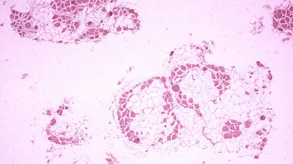 ChemiCare / Finanziamento / Farmaco orfano / distrofia di Duchenne