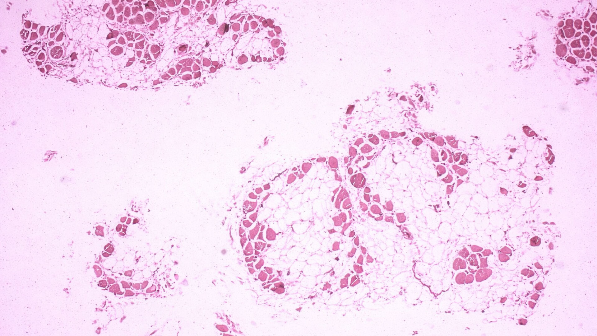 ChemiCare / Finanziamento / Farmaco orfano / distrofia di Duchenne